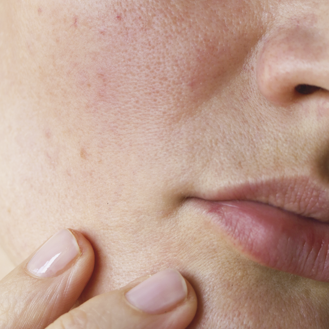 INNO-EXFO® Redness HRP